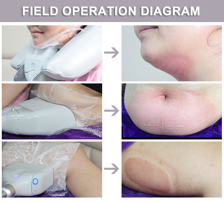 Professional 360° Cryotherapy Fat Freezing Machine for Non-Invasive Fat Reduction & Body Contouring