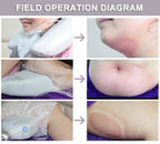 Professional 360° Cryotherapy Fat Freezing Machine for Non-Invasive Fat Reduction & Body Contouring