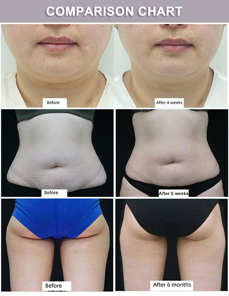 Professional 360° Cryotherapy Fat Freezing Machine for Non-Invasive Fat Reduction & Body Contouring