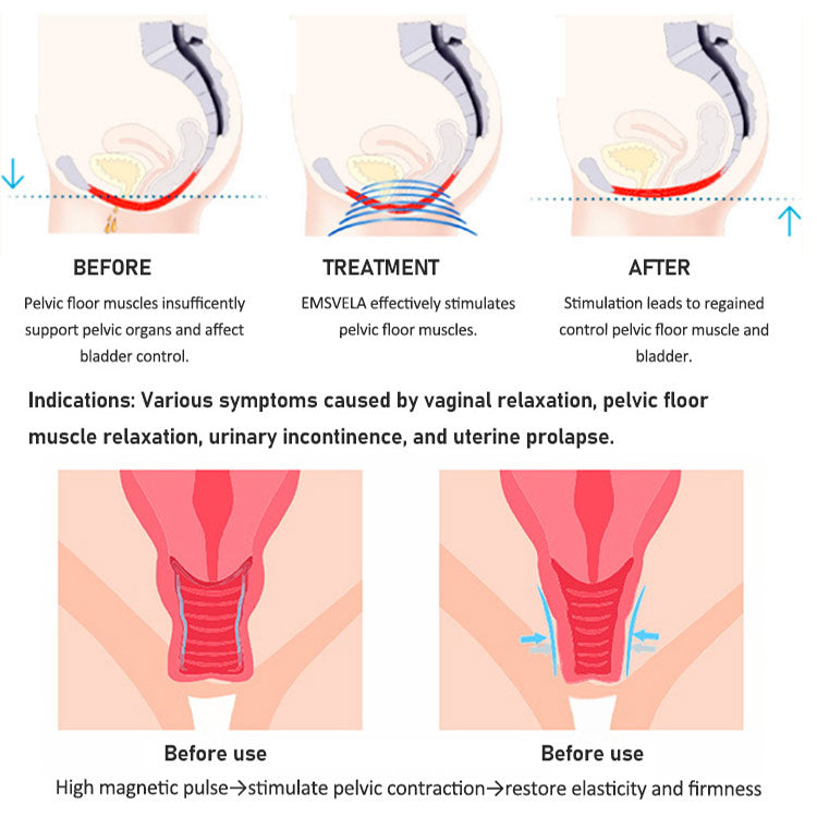 Professional Portable EMS + RF Pelvic Floor Muscle Stimulator for Pelvic Health & Body Toning