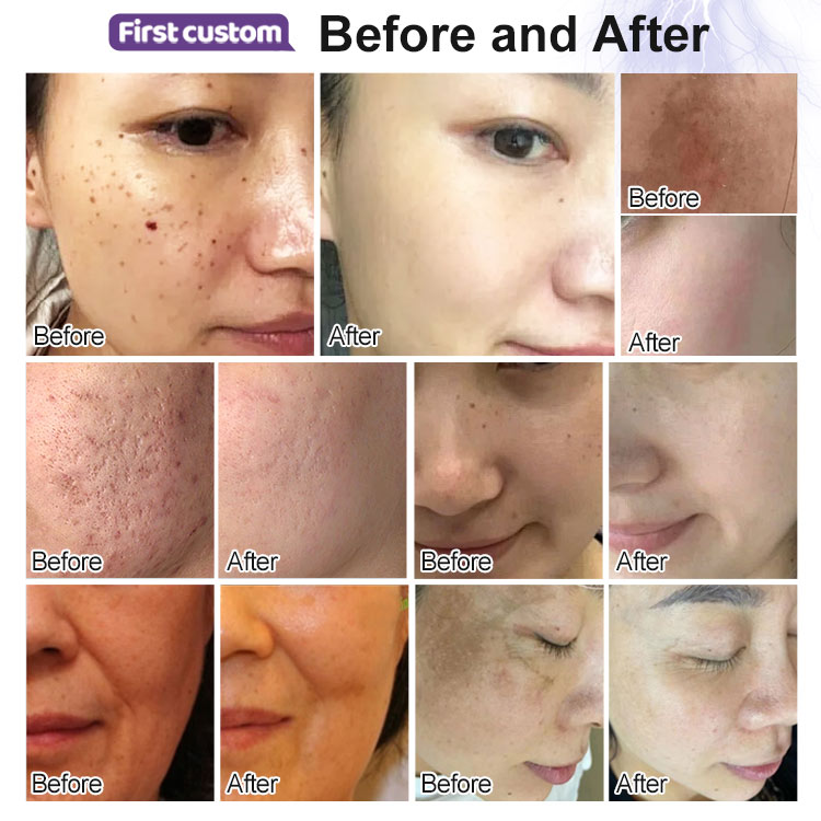 Professional 9-in-1 Cold Plasma Machine for Skin Rejuvenation & Acne Treatment