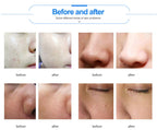 Professional 11-in-1 Hydro Facial Machine for Deep Cleansing & Skin Rejuvenation