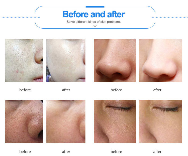 Professional 11-in-1 Hydro Facial Machine for Deep Cleansing & Skin Rejuvenation