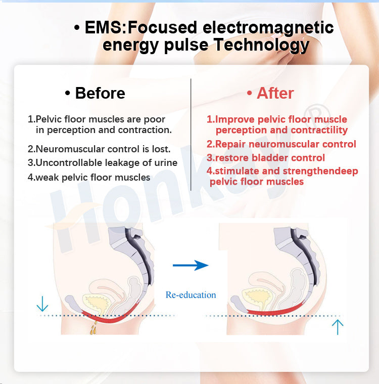 Professional EMS Pelvic Floor Chair for Urinary Incontinence & Pelvic Health