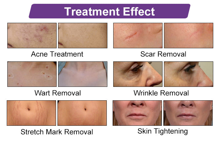 Professional 10600nm Fractional CO2 Laser Machine for Skin Resurfacing & Scar Removal