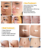 Professional 3-in-1 Fractional RF Microneedling Machine for Skin Rejuvenation & Scar Treatment