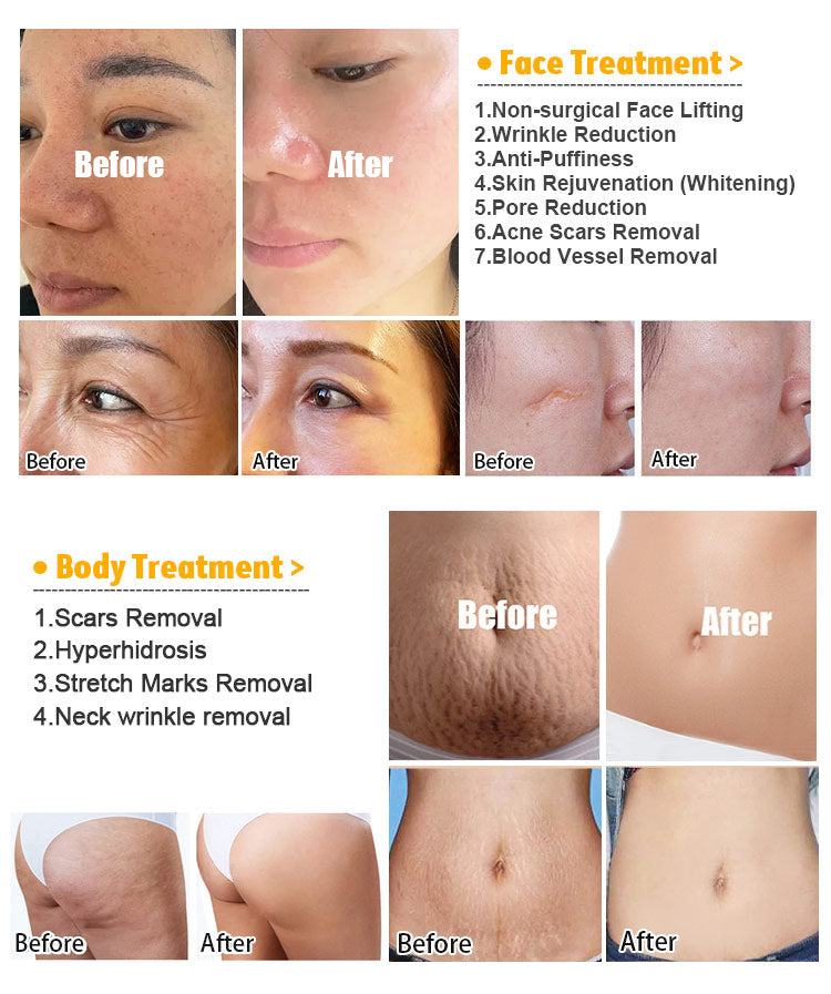 Professional 3-in-1 Fractional RF Microneedling Machine for Skin Rejuvenation & Scar Treatment