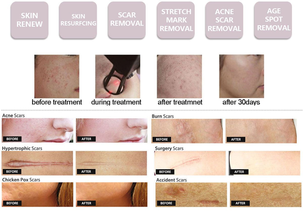 Professional CO2 Fractional Laser Machine for Skin Resurfacing