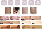 Professional CO2 Fractional Laser Machine for Skin Resurfacing
