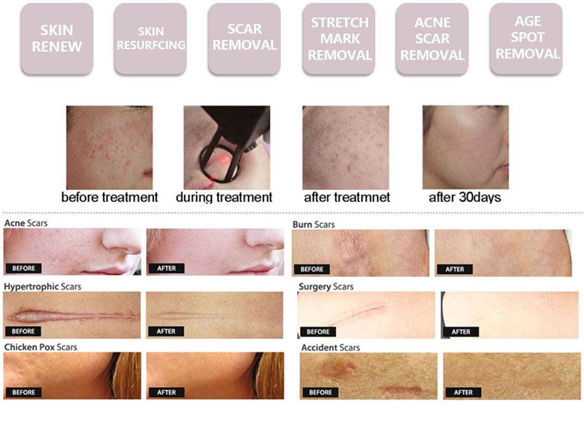 Professional CO2 Fractional Laser Machine for Skin Resurfacing