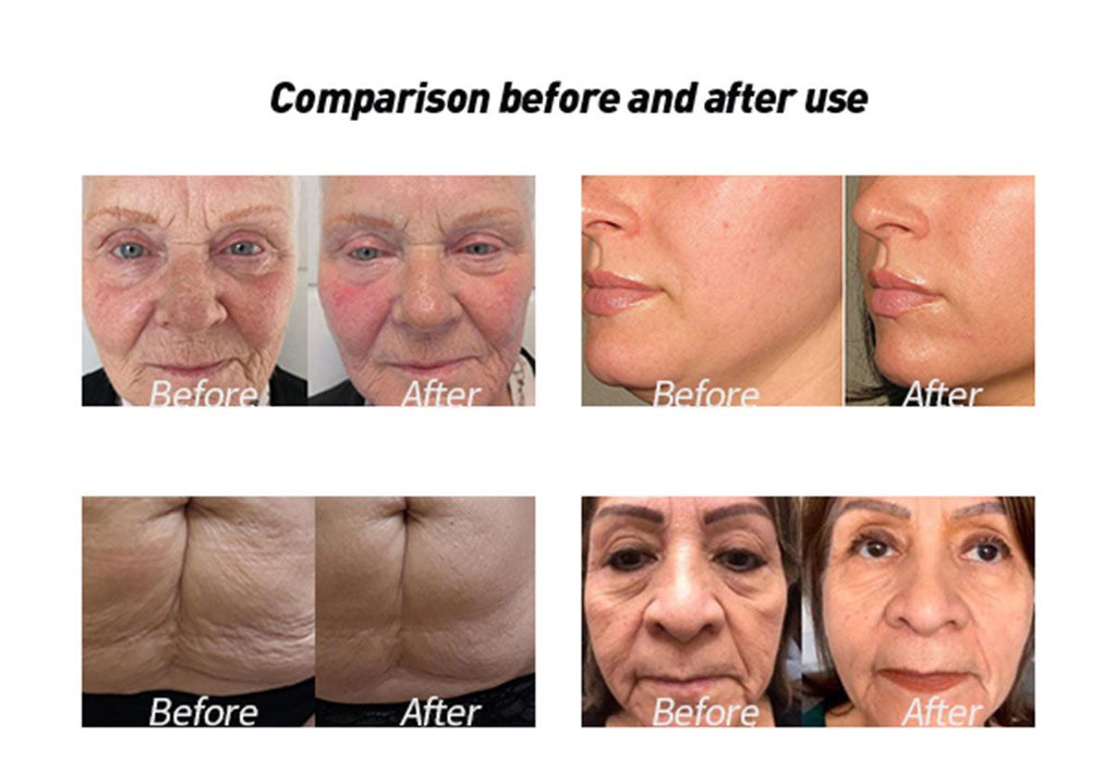 Professional 11D HIFU Face Lifting Machine - Korean Technology