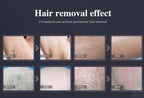 Portable Diode Laser Hair Removal Machine