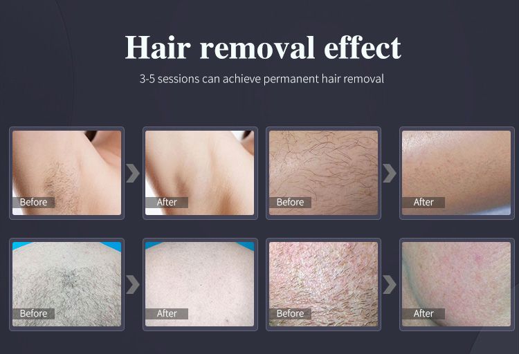 Portable Diode Laser Hair Removal Machine