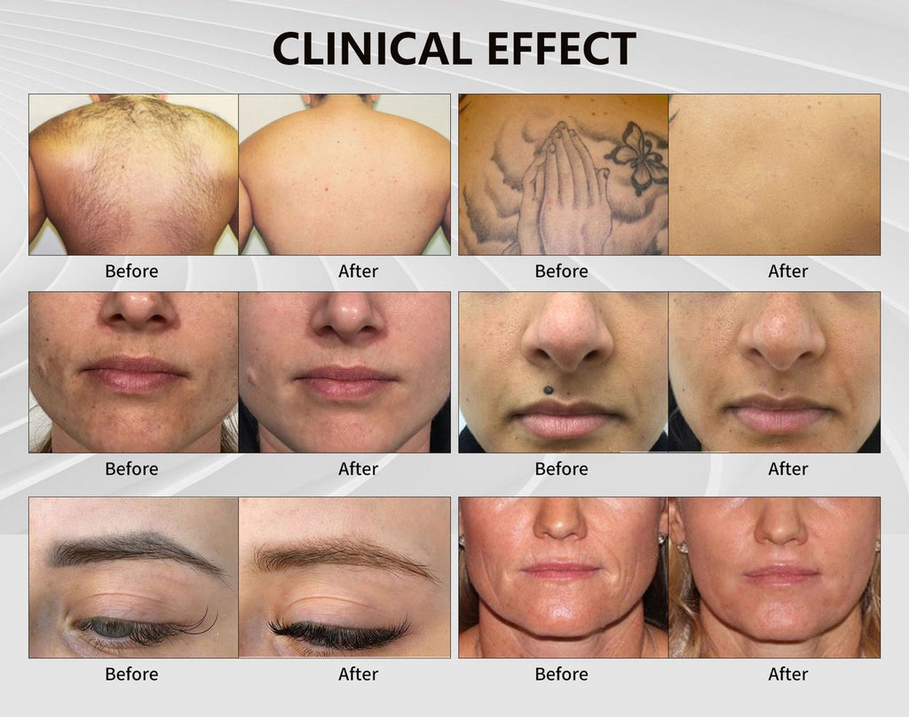 Professional Nd:YAG Laser Machine for Tattoo Removal and Pigmentation