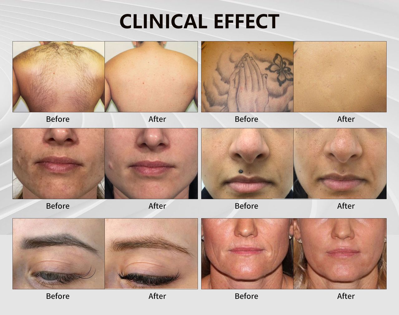 Professional Nd:YAG Laser Machine for Tattoo Removal and Pigmentation