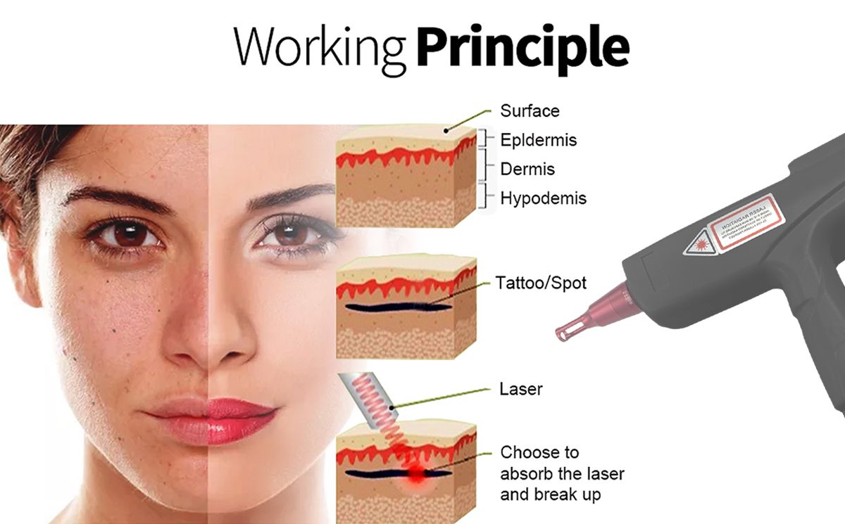 Professional Nd:YAG Laser Machine for Tattoo Removal and Pigmentation